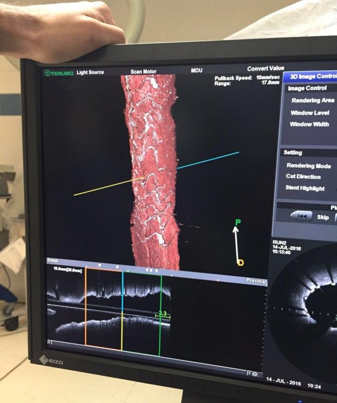 SAN_stent_absorbible