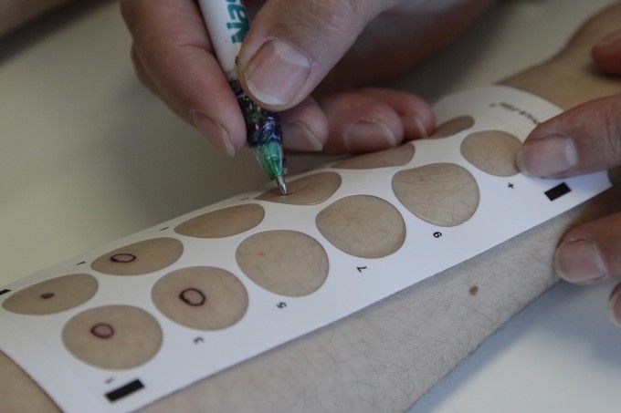 Prueba diagnóstica de alergias